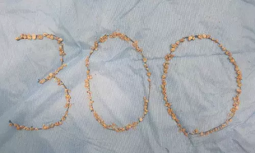 Hyderabad hospital removes 300 kidney stones from 75-year-old man