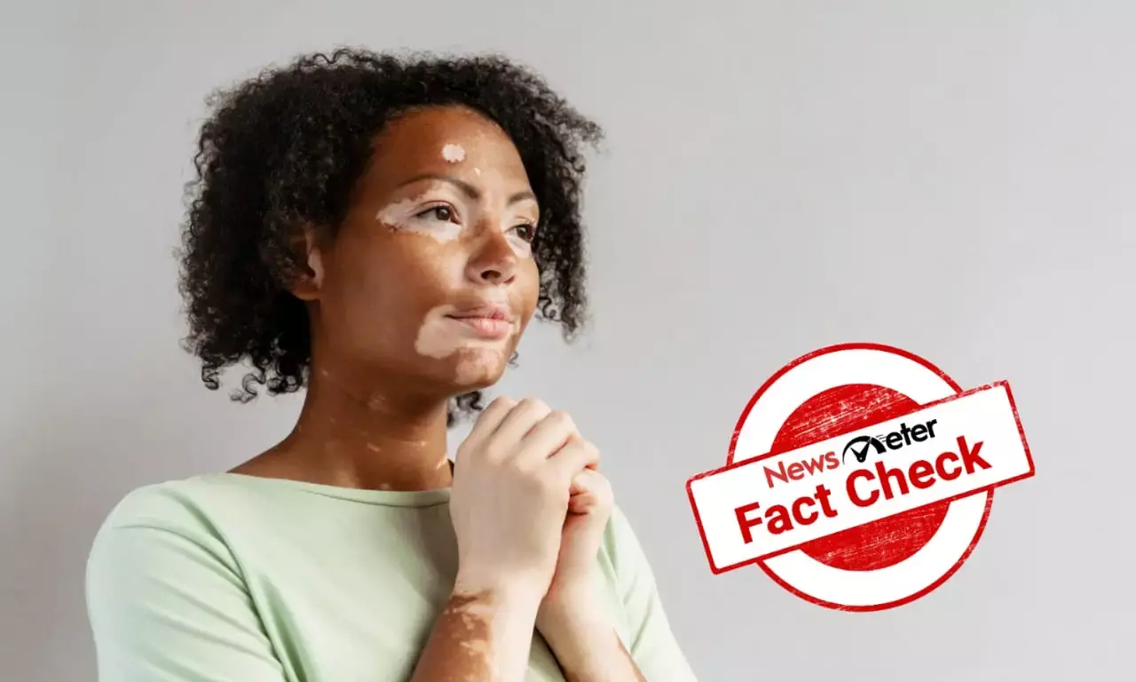 Can an over-the-counter ointment cure vitiligo completely?