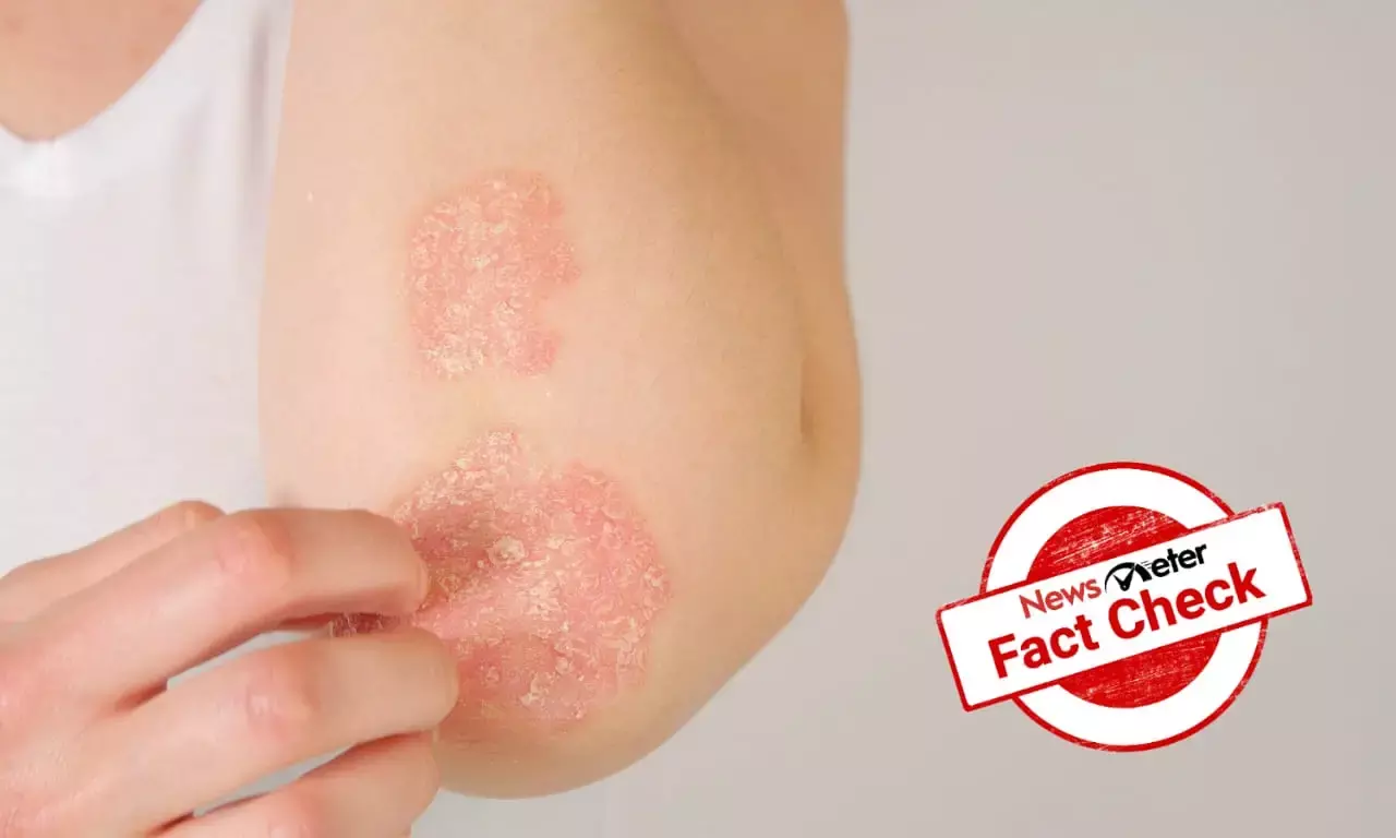Can an over-the-counter ointment cure psoriasis?