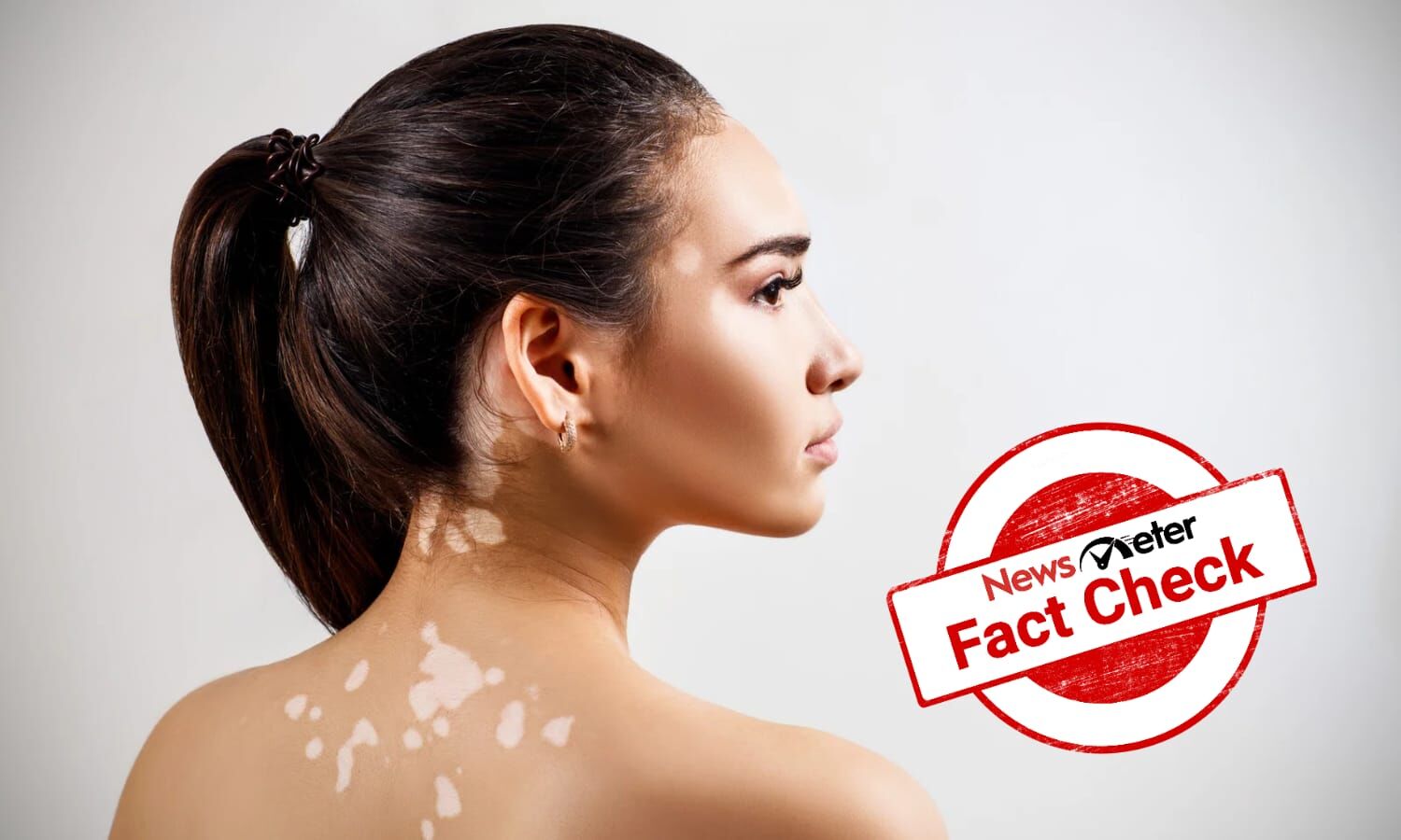 Fact Check: Can a topical spray cure vitiligo in just 4 weeks?