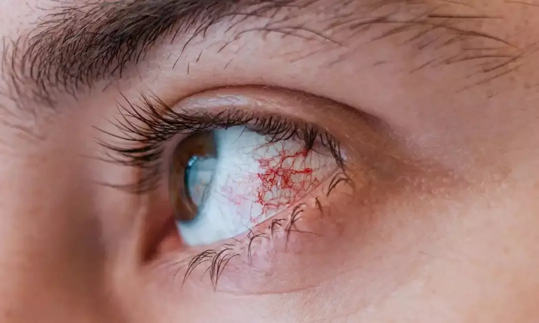 Over 1000 cases of follicular conjunctivitis reported in Andhra, Telangana, Odisha