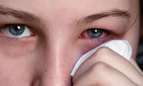 Conjunctivitis outbreak: Eye drops, antibiotics go off shelves in Hyderabad