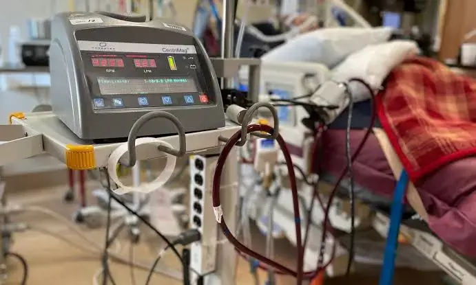 Hyderabad doctors save infant from pneumonia using ECMO