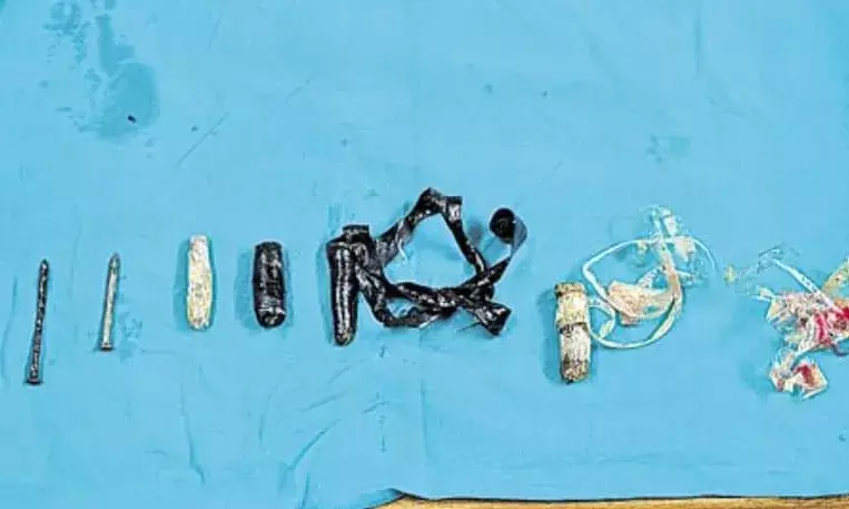 Blade, nails, tape:  Doctors remove sharp objects from Chanchalguda prisoners stomach