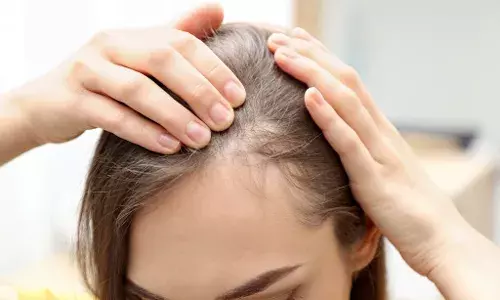 India’s Hair Crisis: How Alopecia is affecting younger men and women