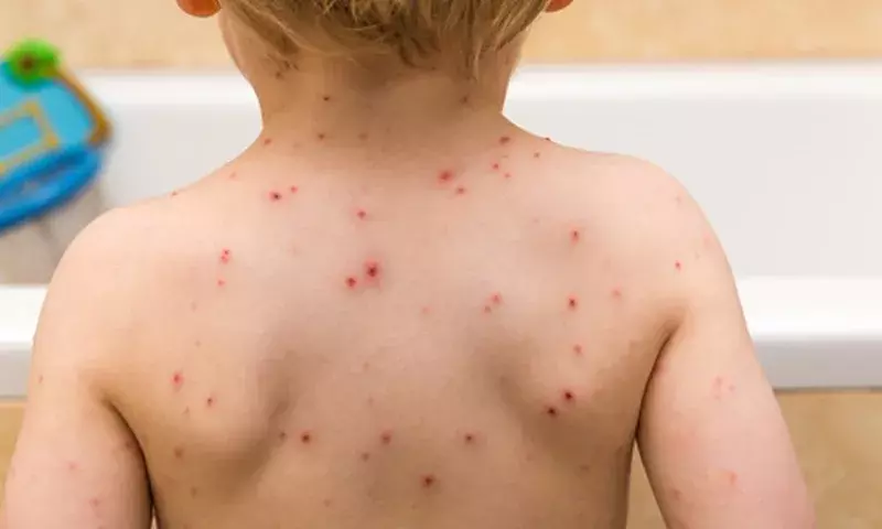 Hyderabad: Chickenpox, flu, respiratory infections cases spike