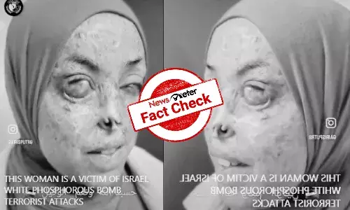 Fact Check: Video of woman with skin ailment shared as victim of Israel’s phosphorous bomb