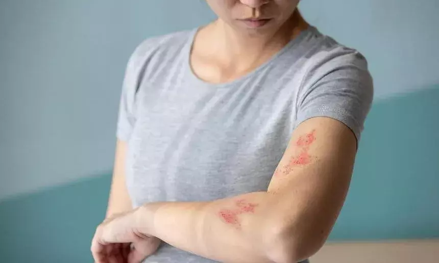 What is Shingles, 80% of Indian adults above 50 underestimate risk