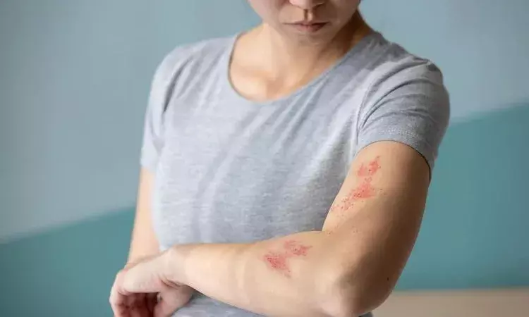 What is Shingles, 80% of Indian adults above 50 underestimate risk