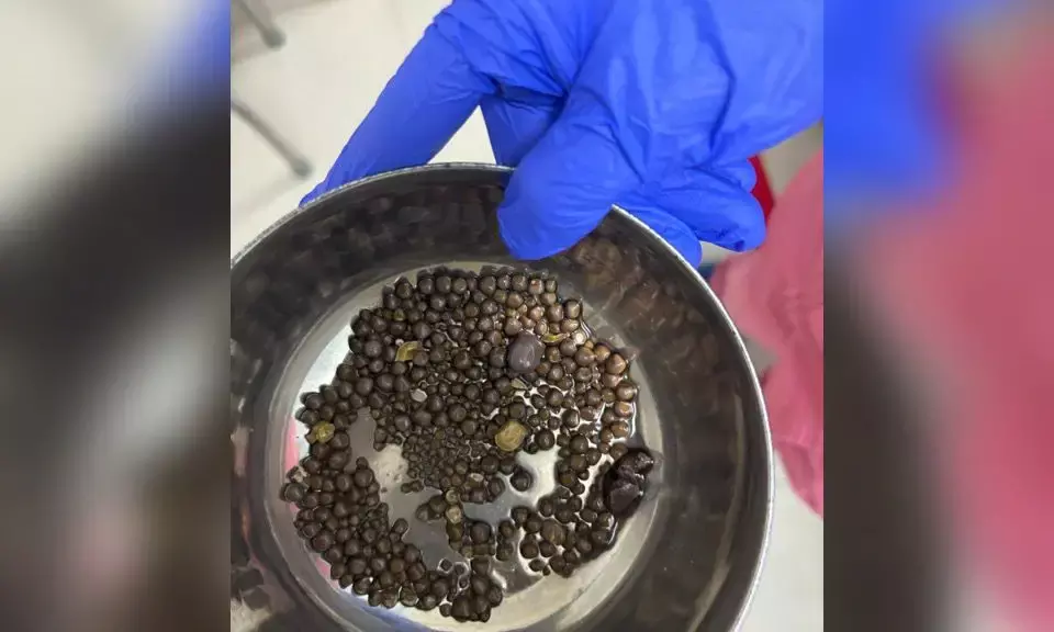 Hyderabad: 418 kidney stones removed from 60-year-old patient by AINU docs