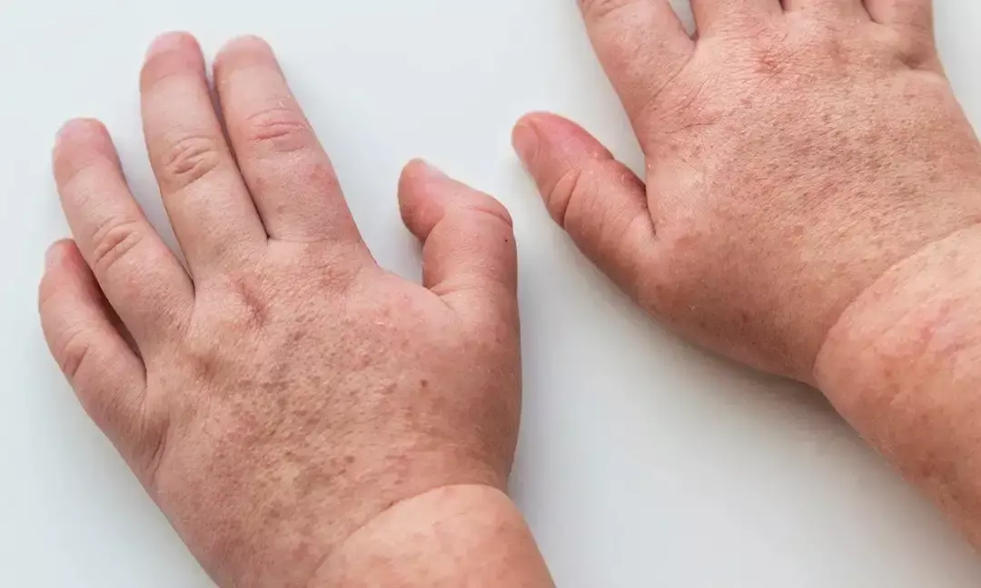 Mumps, scarlet fever resurfacing in Hyderabad: Is dry weather to blame?