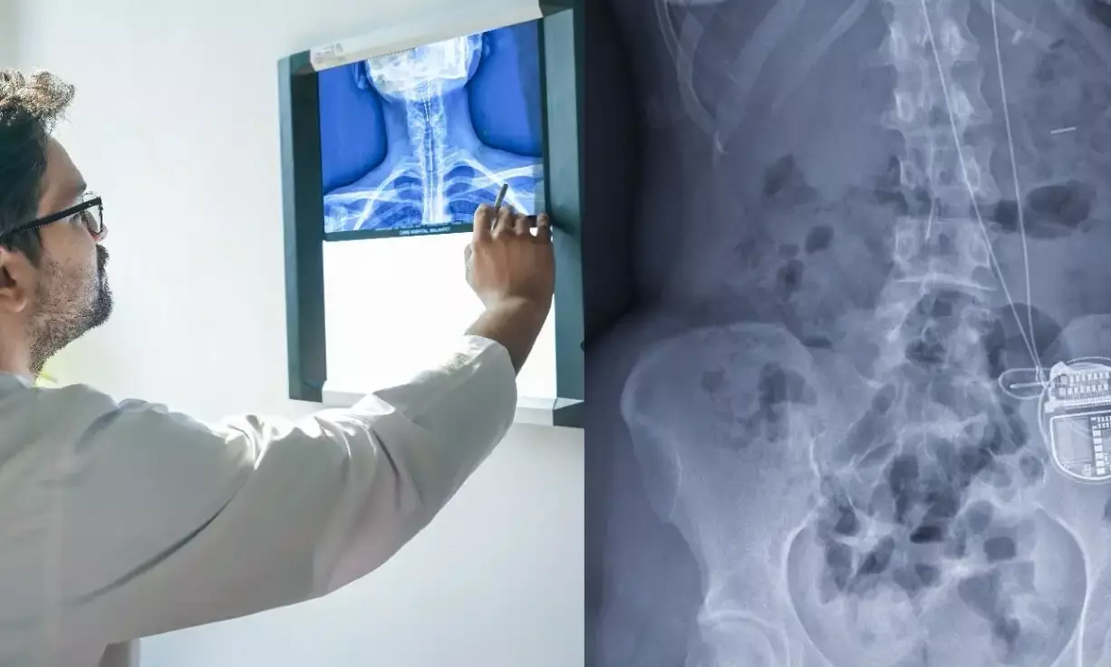 Hyderabad: AIG performs Asia’s first high cervical spinal cord stimulator implantation