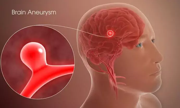 Spotlight on Brain Aneurysms: What you need to know for prevention, treatment