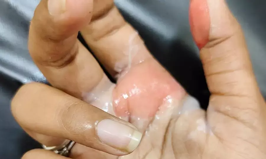 Hyderabad: Female ICFAI student sustains burns; cops rule out acid attack