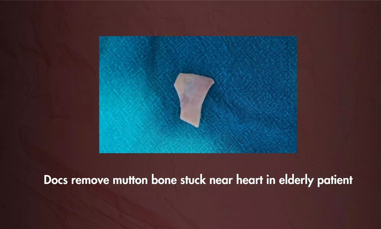 In an unusual case Kamineni docs remove mutton bone stuck near heart in elderly patient