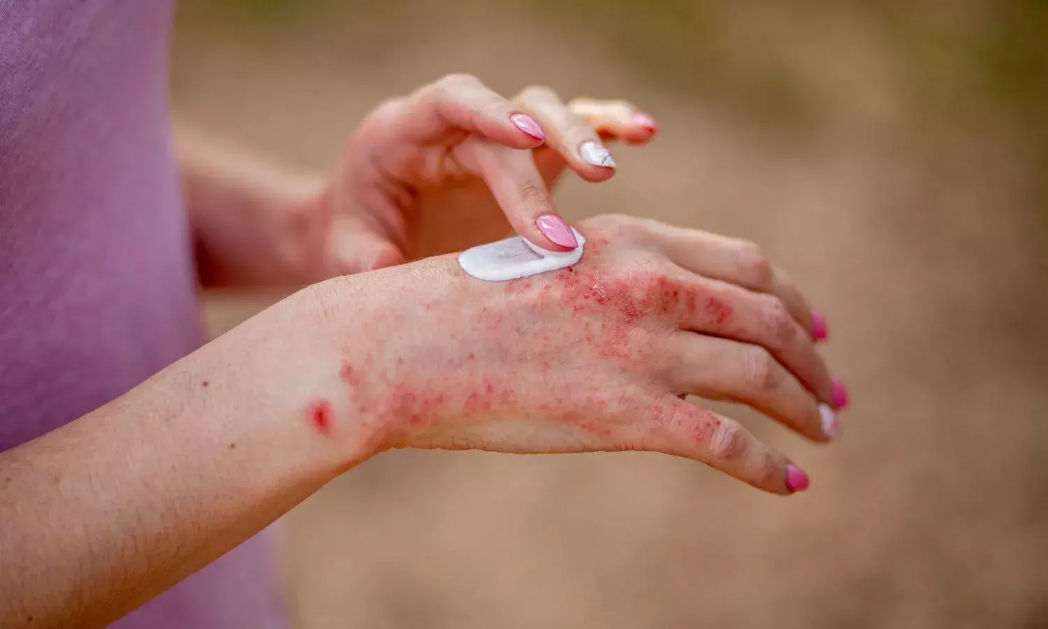 Living with Chronic Hand Eczema: Hyderabad docs offer tips to manage skin disorder