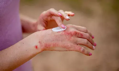 Living with Chronic Hand Eczema: Hyderabad docs offer tips to manage skin disorder
