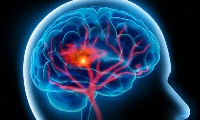 Hyderabad: Apollo hospitals performs advanced mechanical thrombectomy on 4 brain stroke patients in 24 hours