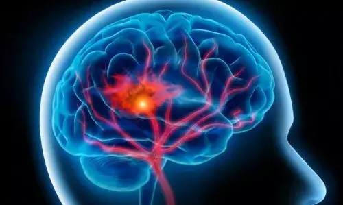 Hyderabad: Apollo hospitals performs advanced mechanical thrombectomy on 4 brain stroke patients in 24 hours