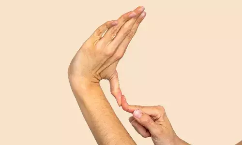 Marfan syndrome: Woman, 18-year-old successfully operated in Hyderabads Kamineni Hospital