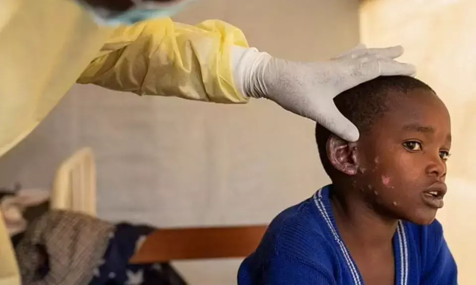 WHO has declared mpox a global health emergency. What happens next?