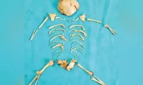 Vizag: KGH doctors perform rare surgery to remove āstone babyā from womanās womb