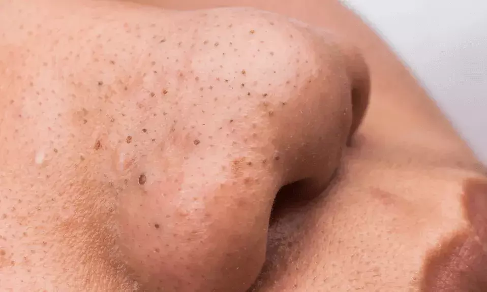 Beware! If you have fever and your nose blackens, it could be Chikungunya