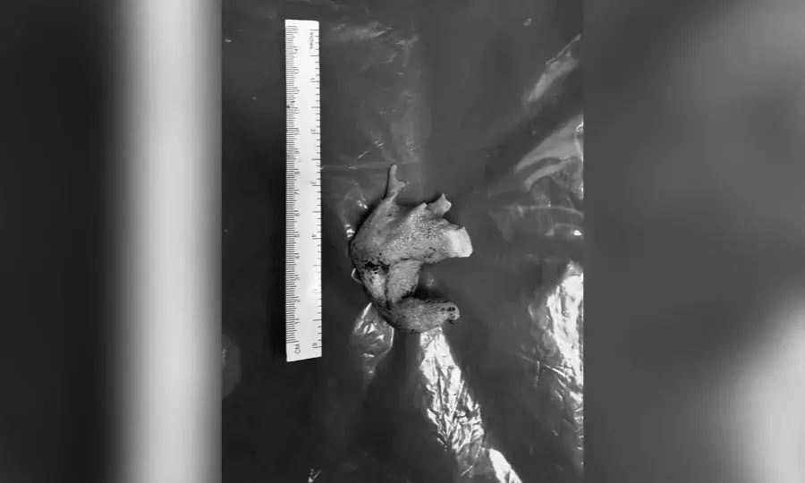 Visakhapatnam: AINU doctors remove kidney stone filling entire organ in farmer