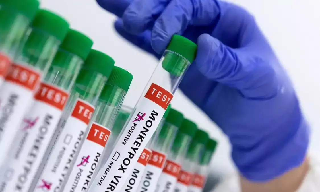 Govt asks states to identify facilities, trained human resources to handle mpox cases