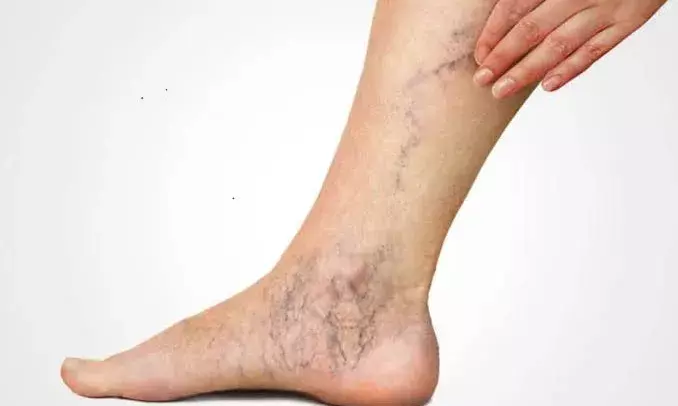 Indian Vein Congress: Countrys 25% population affected by varicose veins