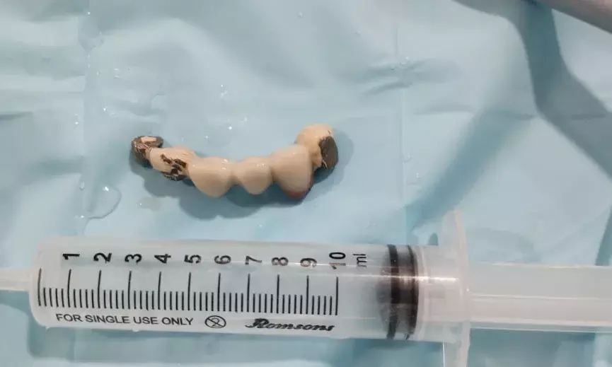 Vizag man swallows dentures in sleep; extracted from lung by KIMS doctors