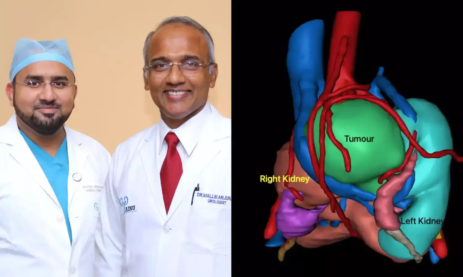 Rare pancake kidney tumour removed via keyhole surgery at Hyderabad AINU