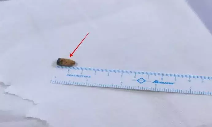 Man lives with pen cap in lungs for 21 years, KIMS Kondapur surgeons remove it