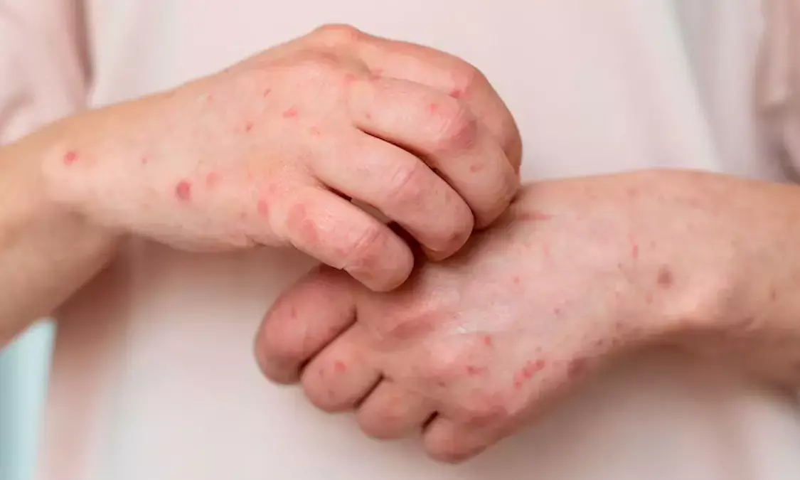 Shingles: 56% Indians above 50 years unaware of painful viral infection despite being at high risk