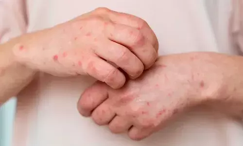 Shingles: 56% Indians above 50 years unaware of painful viral infection despite being at high risk