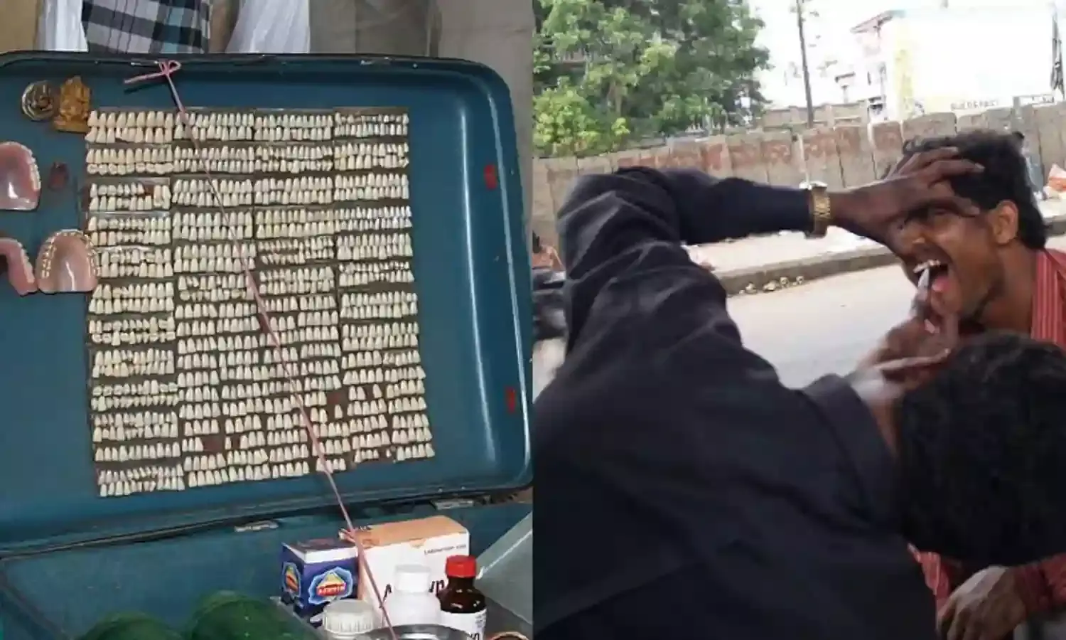 Inflamed gums, lost teeth: The hidden dangers of unqualified dentists in Hyderabad