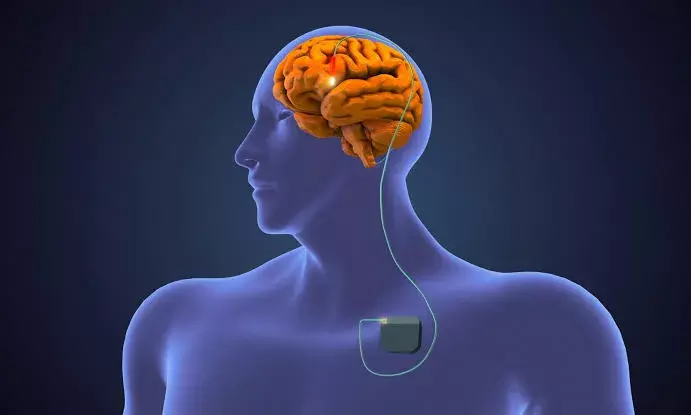 What is adaptive DBS? How it helps in treating Parkinson’s disease