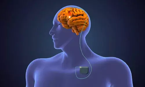 What is adaptive DBS? How it helps in treating Parkinson’s disease