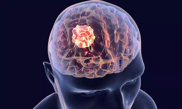 Understanding causes, symptoms, precautions, and treatment of Brain Tumor