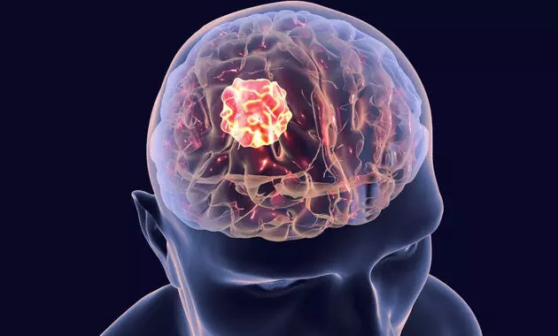 Understanding causes, symptoms, precautions, and treatment of Brain Tumor Understanding causes, symptoms, precautions, and treatment of Brain Tumor