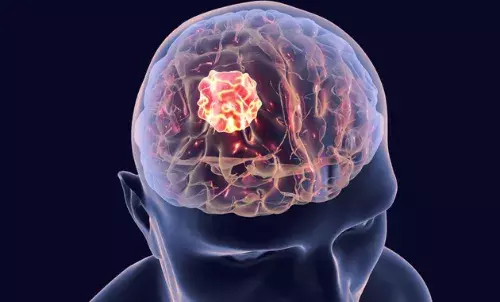 Understanding causes, symptoms, precautions, and treatment of Brain Tumor