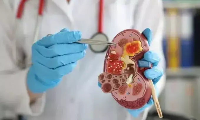 Don’t ignore the signs: Doctors warn of common kidney cancer symptoms