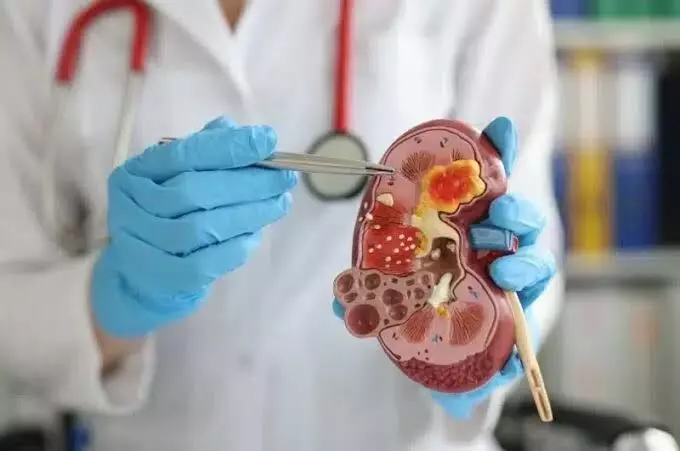 Don’t ignore the signs: Doctors warn of common kidney cancer symptoms Don’t ignore the signs: Doctors warn of common kidney cancer symptoms