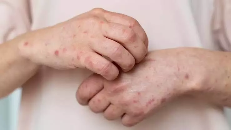Fungal infections spike in monsoon: Wet surfaces perfect environment for growth, spread of fungi Fungal infections spike in monsoon: Wet surfaces perfect environment for growth, spread of fungi