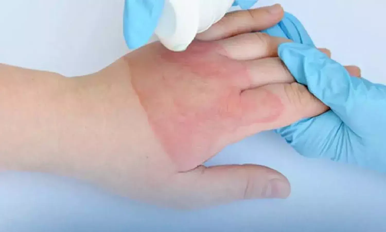 India burn injuries statistics, India annual burn deaths, burn injury mortality rate India statistics