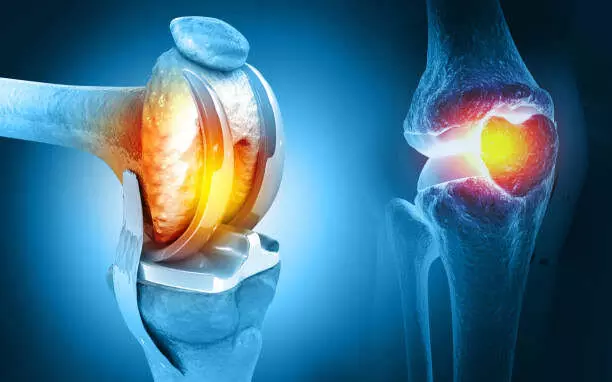 Advanced knee surgeries: KIMS ICON Vizag doctors restore mobility in two obese patients Advanced knee surgeries: KIMS ICON Vizag doctors restore mobility in two obese patients