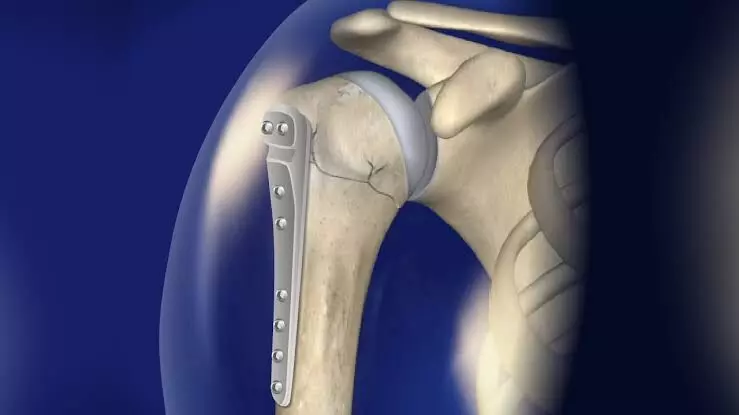 Rare surgery on Khammam man with fractures in both shoulder joints done at Renova Hospitals Rare surgery on Khammam man with fractures in both shoulder joints done at Renova Hospitals