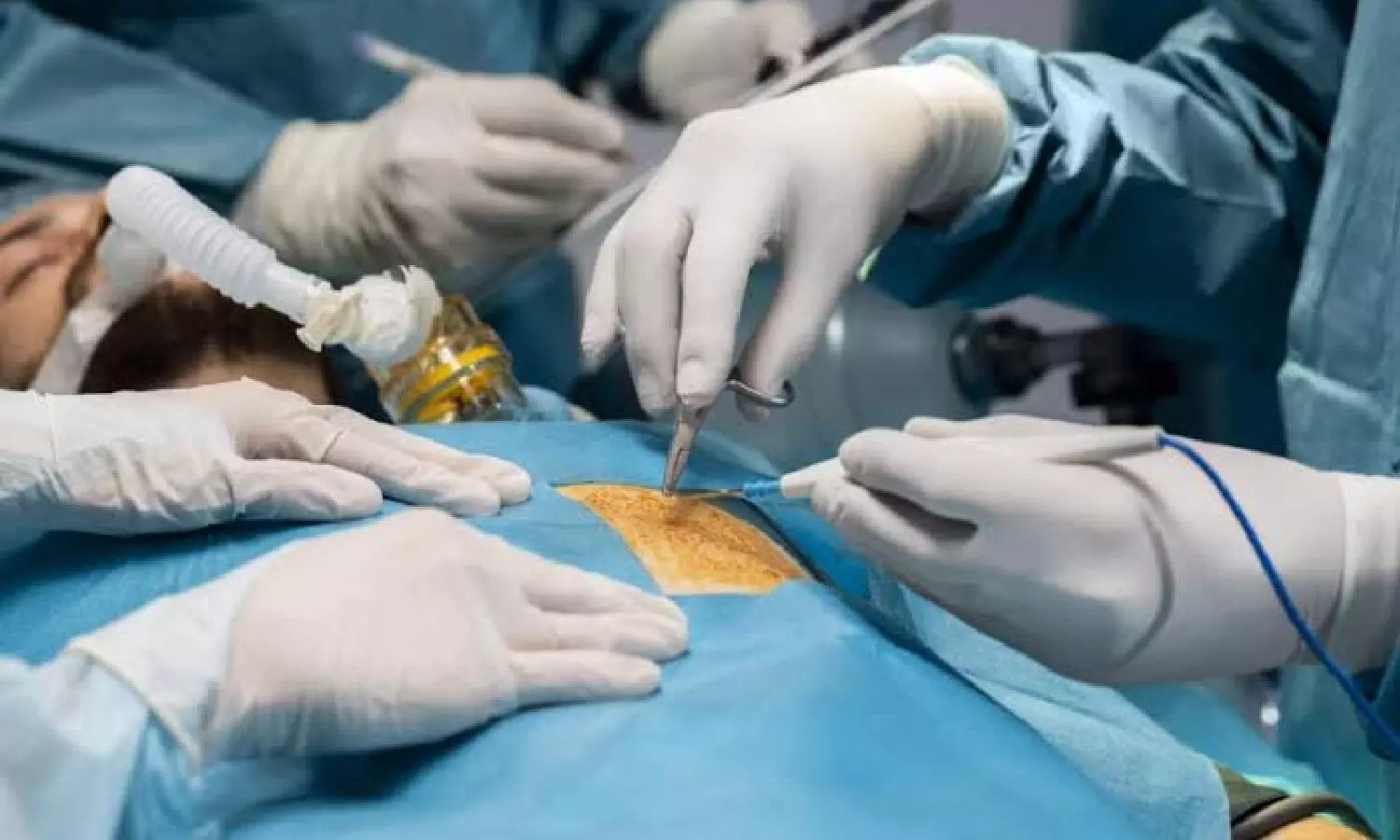 `Be heart smart’: How MICS is emerging as an alternative to conventional open-heart surgery `Be heart smart’: How MICS is emerging as an alternative to conventional open-heart surgery