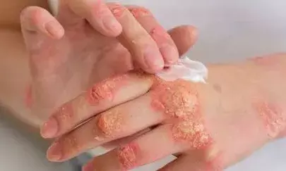 ICMR, IIT-M, Wadhwani develop novel way against Candida, a lethal fungal pathogen