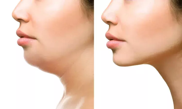Kybella: How the chin slimming injection works and what to expect